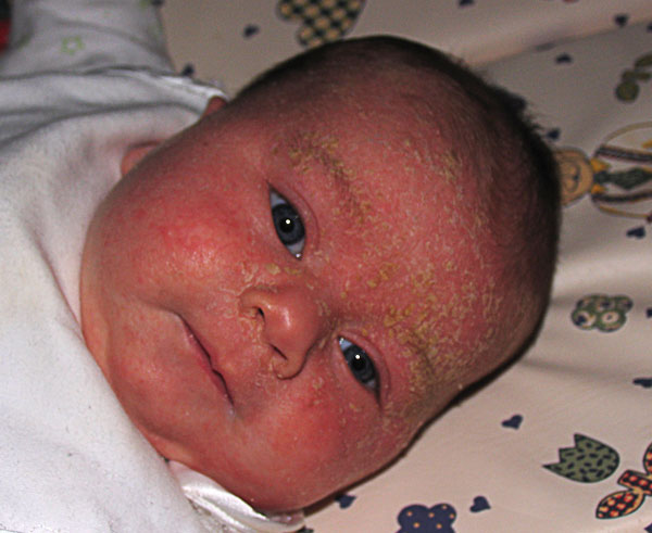 Maia, 6 weeks old, severe cradle cap.